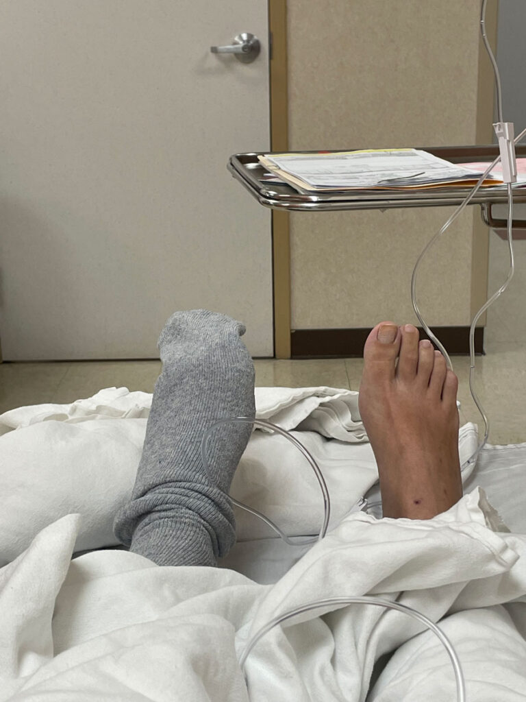 Surgery for neuromas