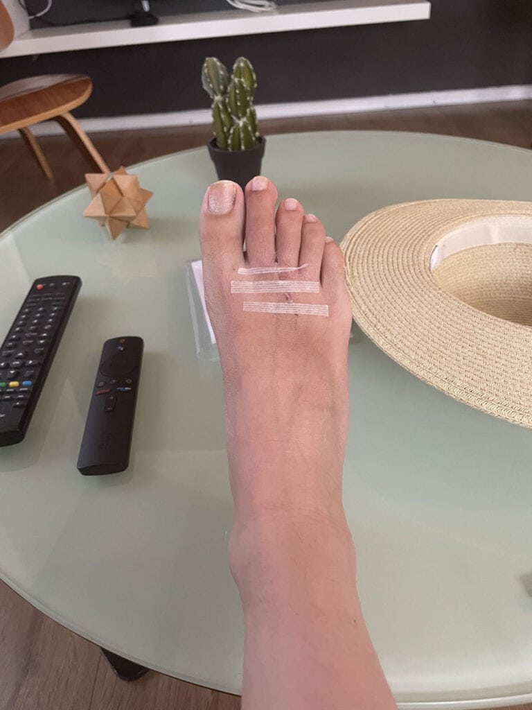 Recovering from surgery for neuromas