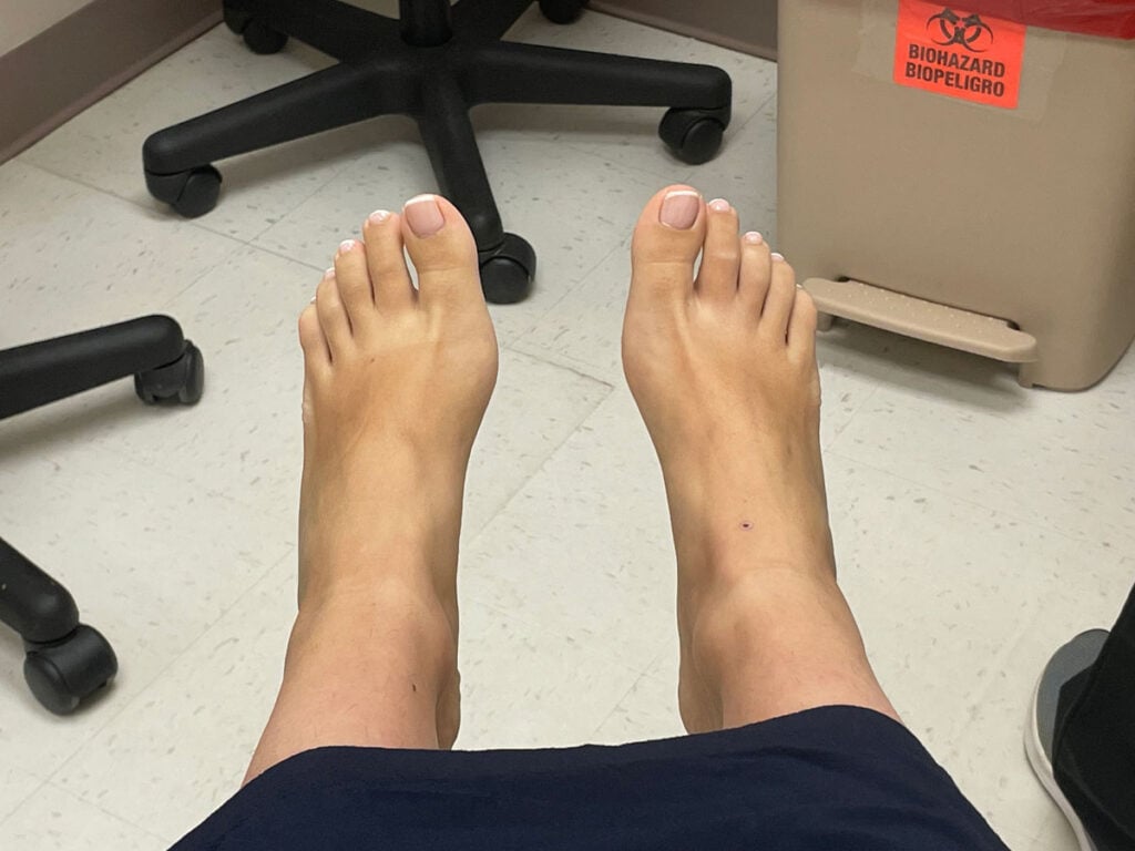 Before wearing barefoot shoes, Cheyenne in 2022